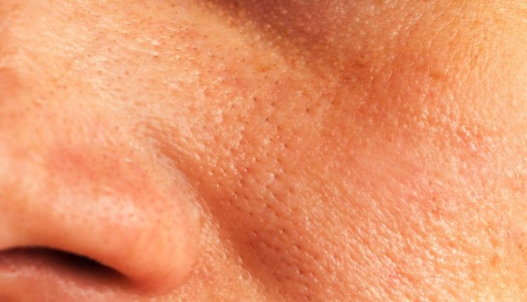 وصفات لعلاج المسام الواسعة من السكر وخل التفاح